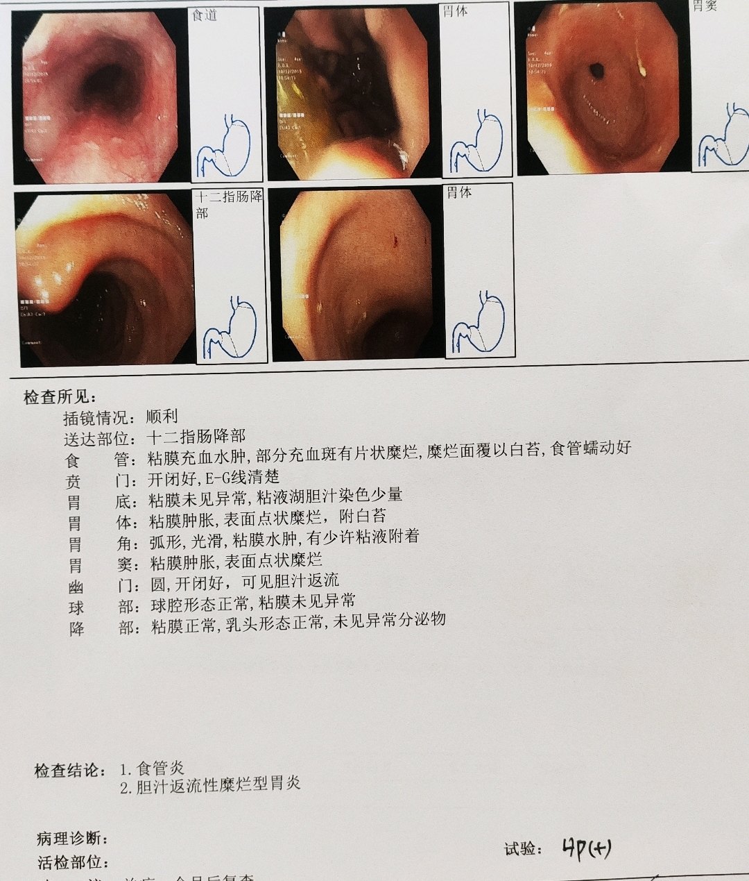 胃的图片 幽门图片