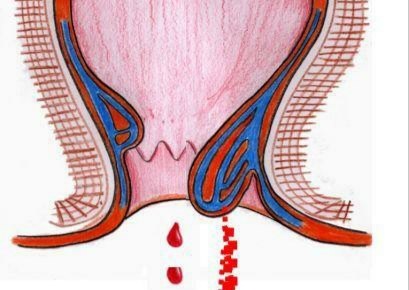 科普小文之痔疮