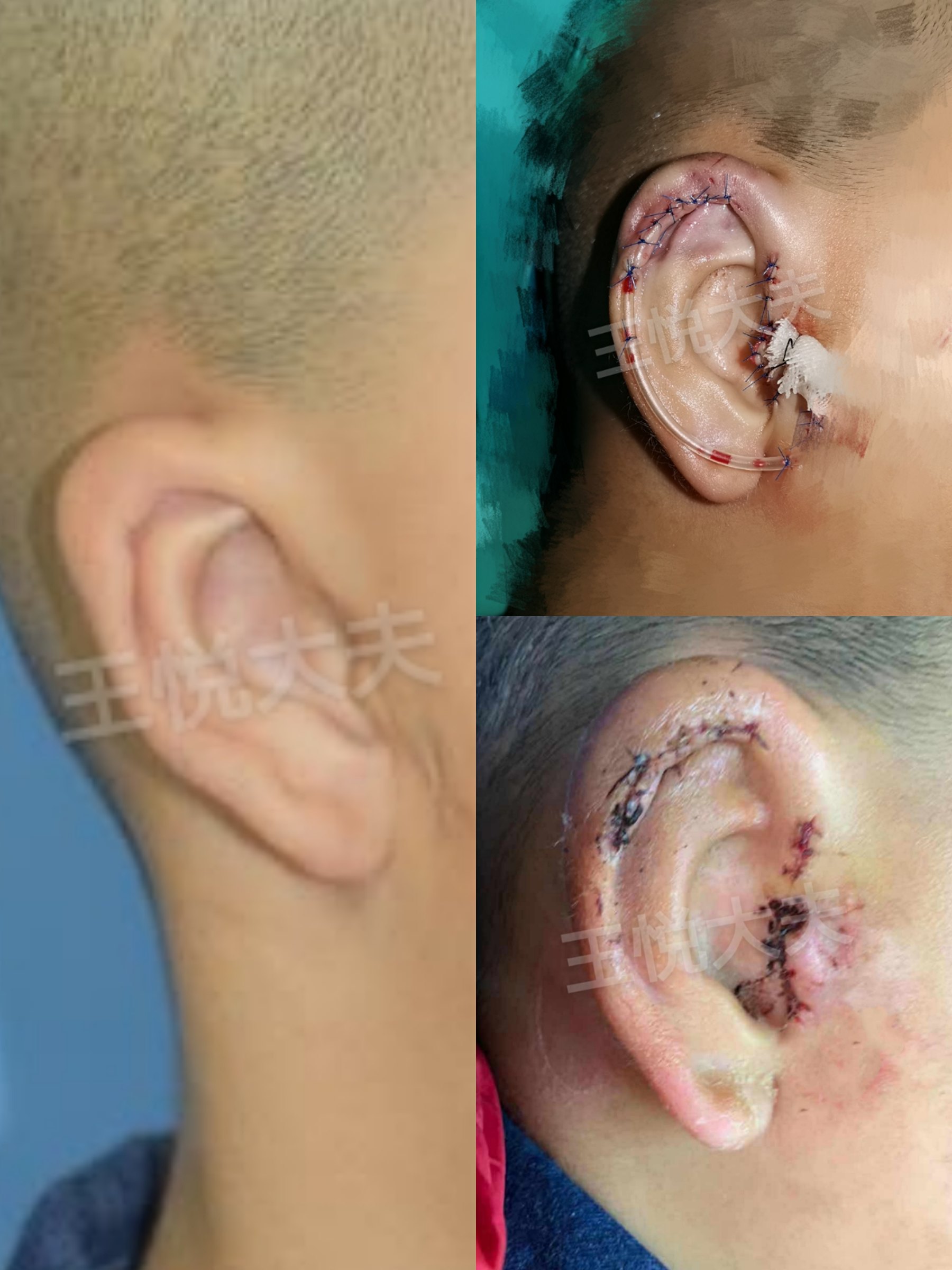 小耳畸形手术后照片图片