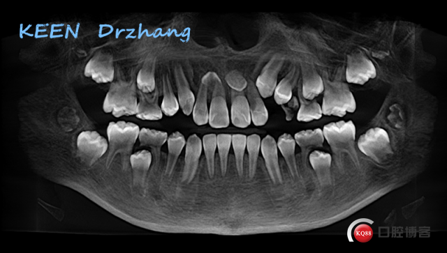 一般来说,如果确定是多生牙的情况下且多生牙已经萌出,可以采用局部