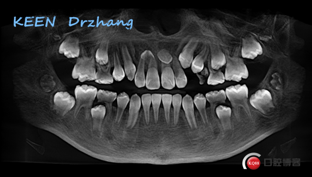 多生牙全景片图片