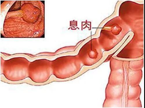 直肠息肉.jpg