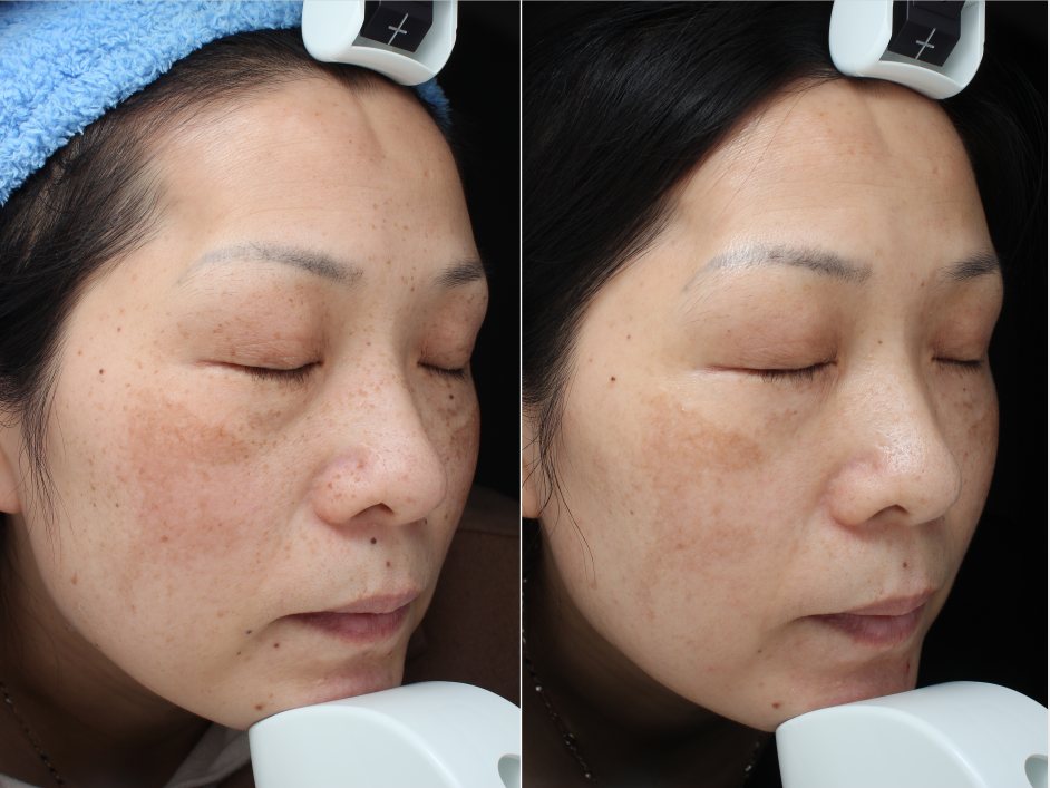 祛斑 - 好大夫在线