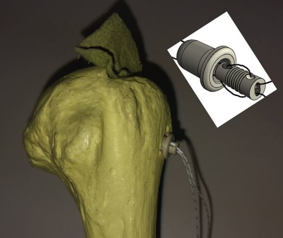 采用atok(穿骨无结锚钉)肩关节镜下修复肩袖损伤怎么样?