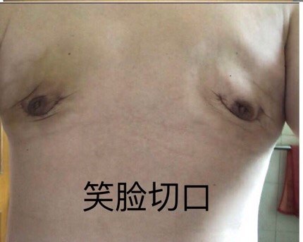 浅谈男性乳腺发育症各种手术方法 男性乳房肥大