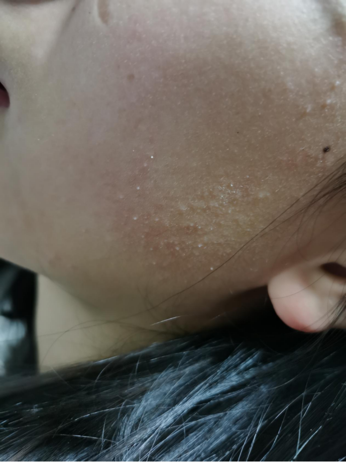 鸡皮肤手术处理(鸡皮肤手术处理方法) 鸡皮肤手术处理(鸡皮肤手术处理方法)