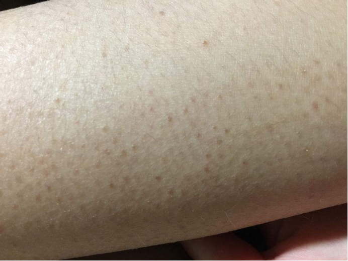 鸡皮肤擦什么药可以好(鸡皮肤擦什么药可以好得快) 鸡皮肤擦什么药可以好(鸡皮肤擦什么药可以好得快)