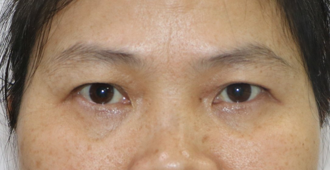 核性眼肌麻痹图片