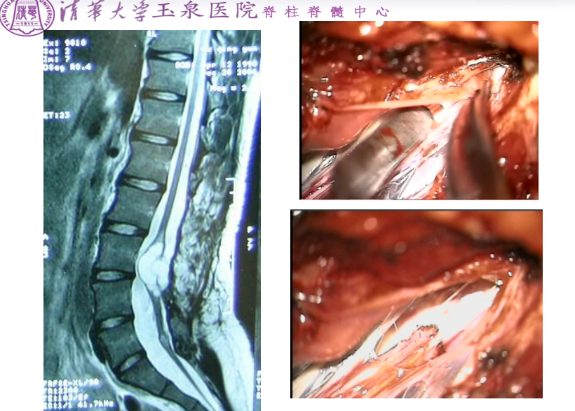 脊髓腸源性囊腫是少見的椎管內先天性瘤樣病變