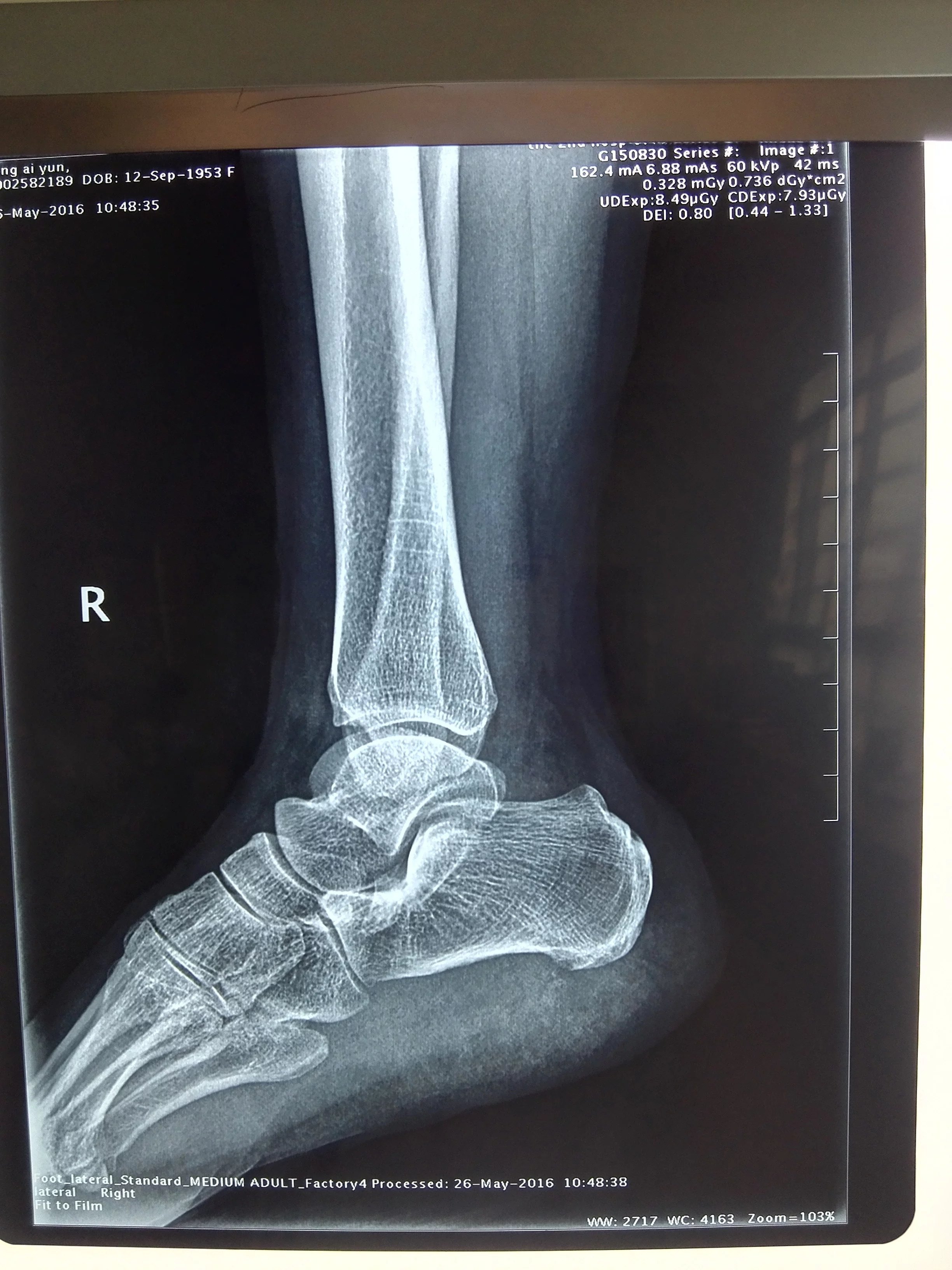 足底筋膜炎足跟痛常见的一种原因如何诊治可以手术吗