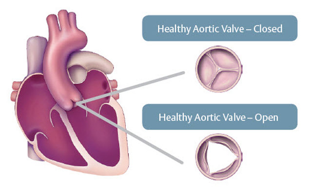 aortic stenosis healthy 640 (1).jpg