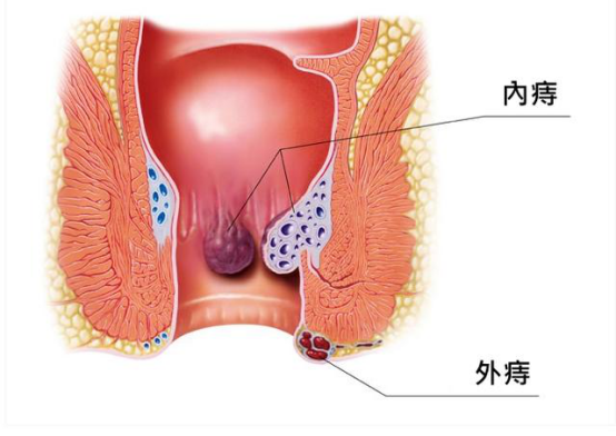 痔科普311.png