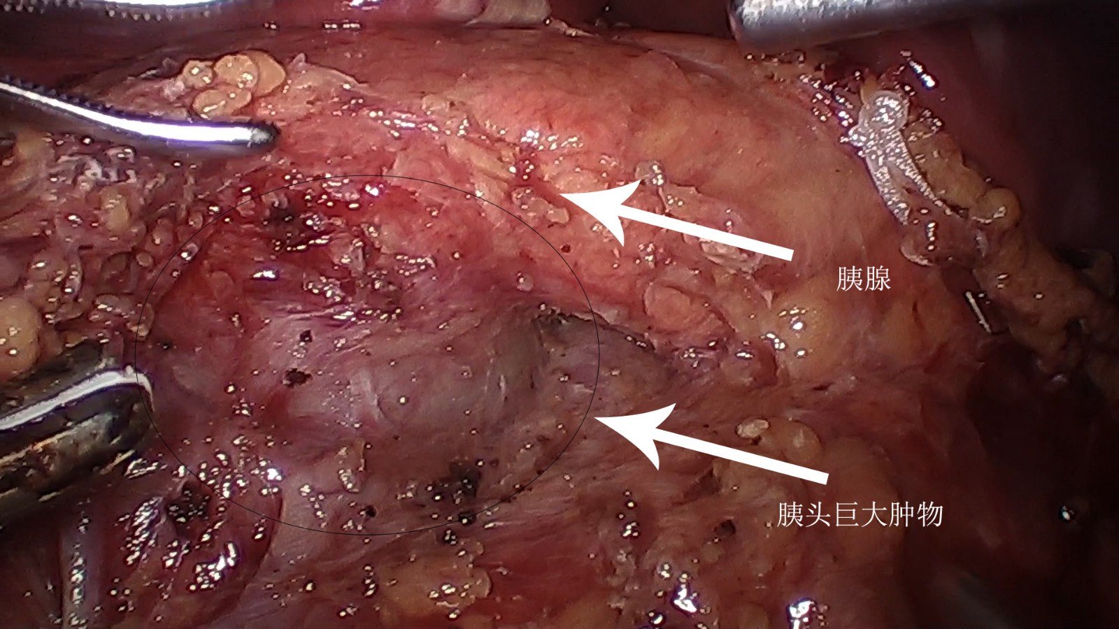 体检发现胰腺实性假乳头状瘤,应该怎么办?