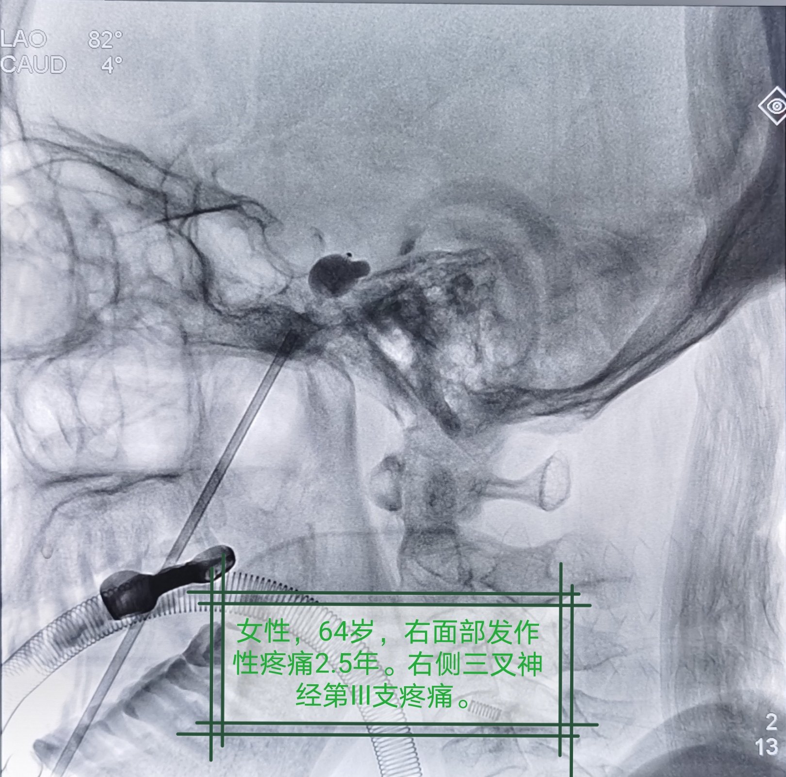 三叉神经半月节微球囊压迫术治疗原发性三叉神经痛_三叉神经痛_三叉