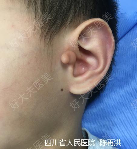 副耳_副耳 - 好大夫在线