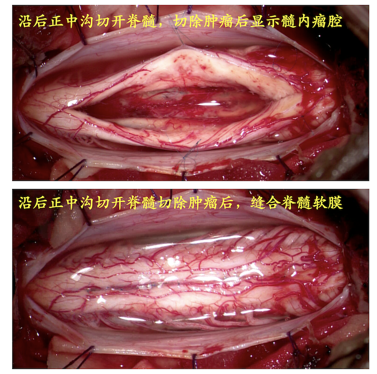 室管膜瘤二级图片