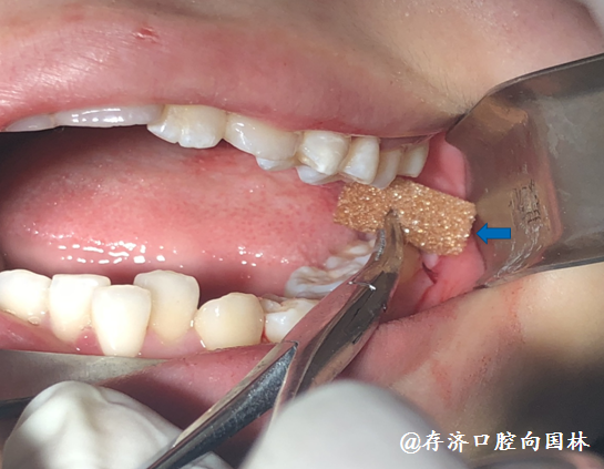 明胶海绵牙齿图片