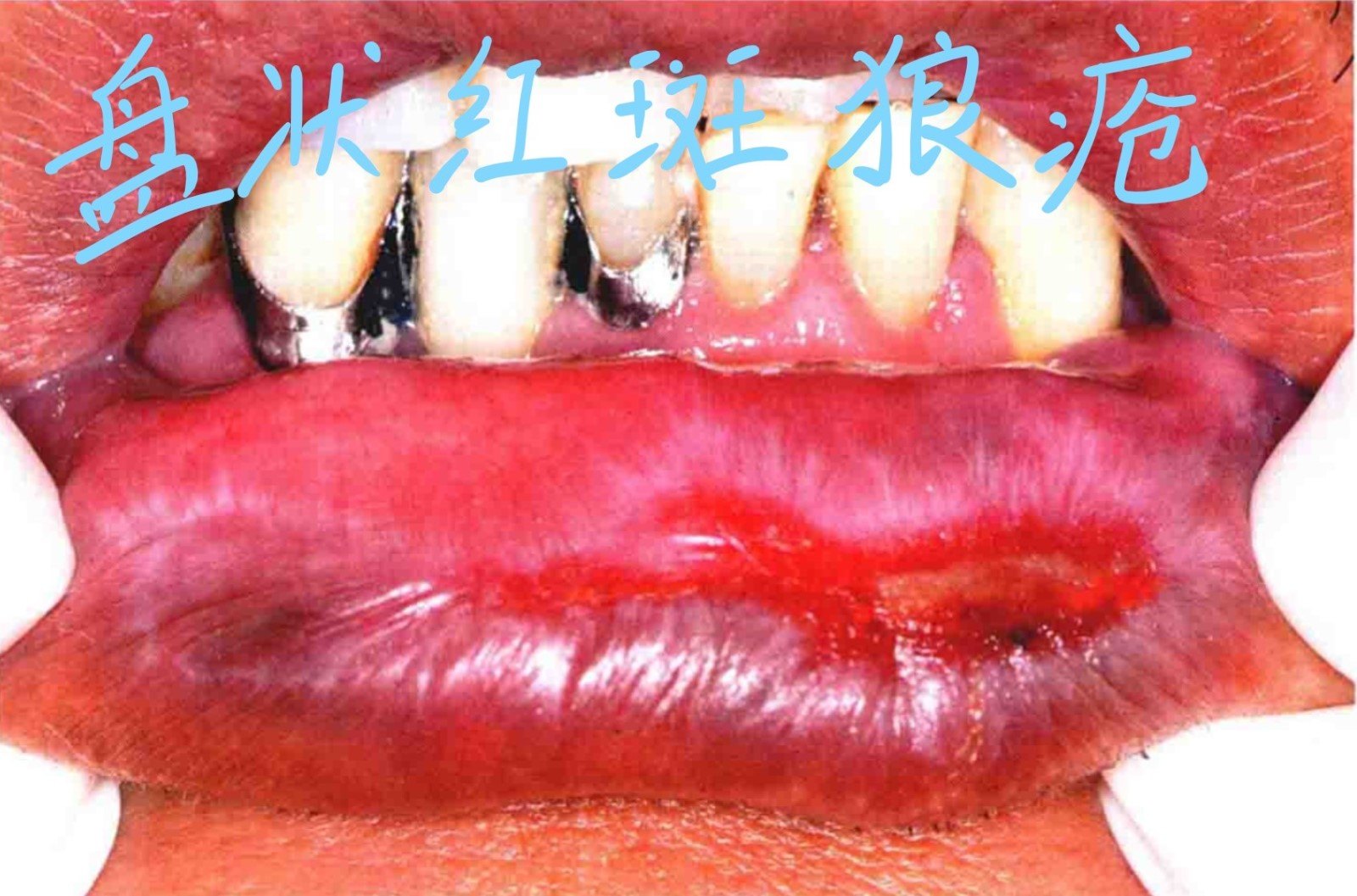 口腔黏膜——罕见角化型白色病变的图文介绍 