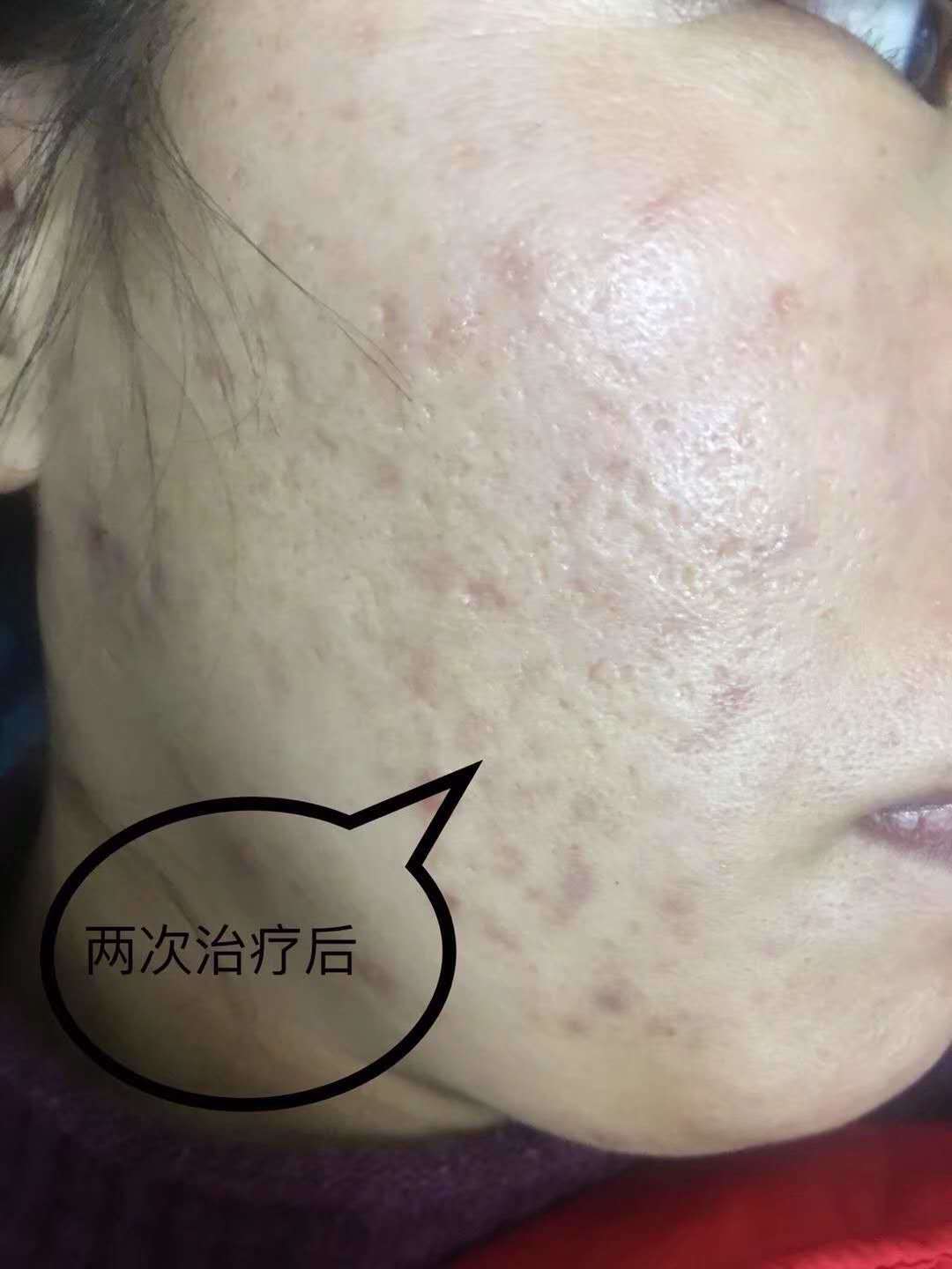 超脉冲二氧化碳点阵激光_激光美容_激光美容治疗介绍 - 好大夫在线