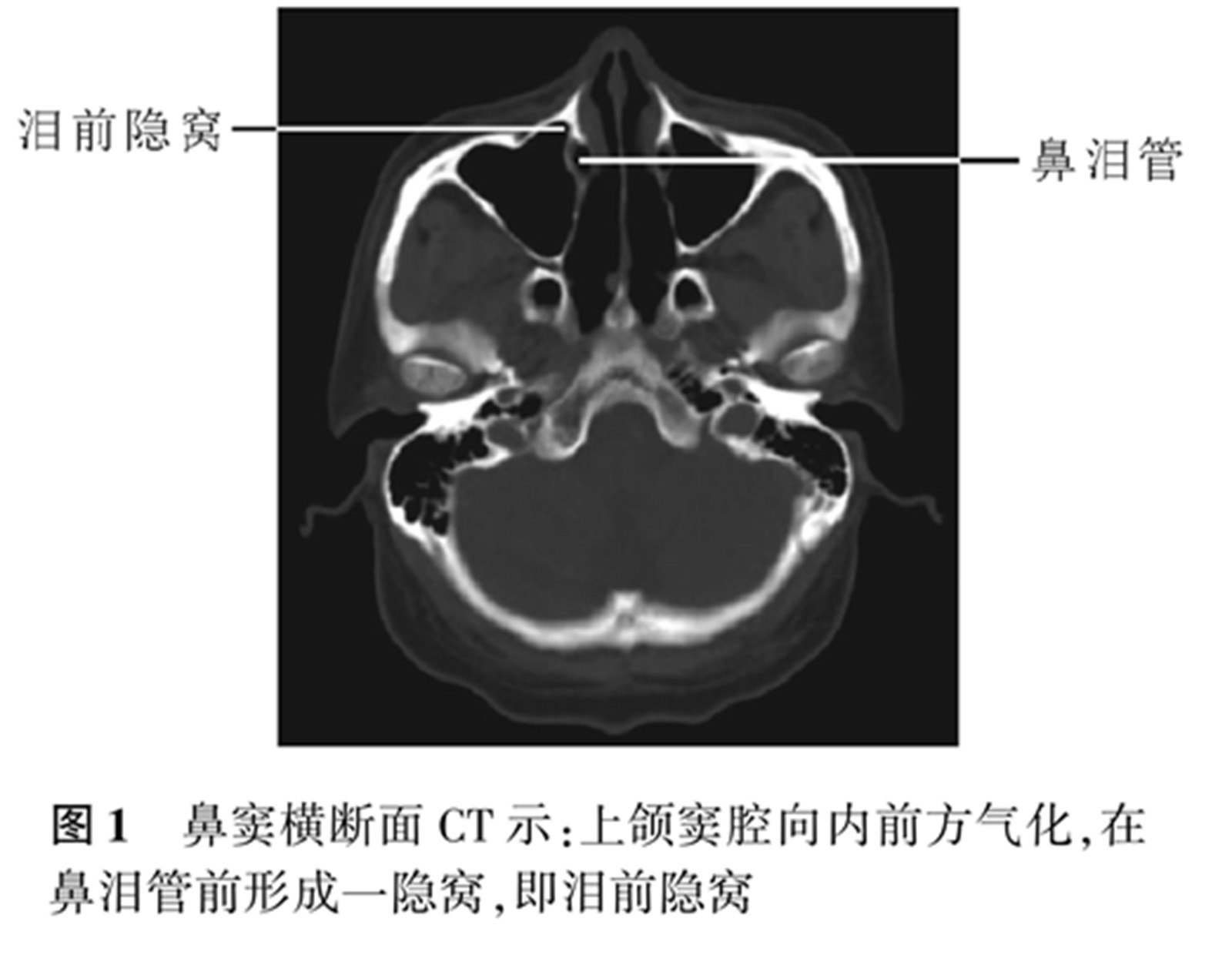 称之为泪前隐窝,可在鼻窦水平位 ct 上清晰显示(图 1)1,泪前隐窝解剖