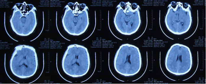 一,李小勇脑脊液中心入院前病史