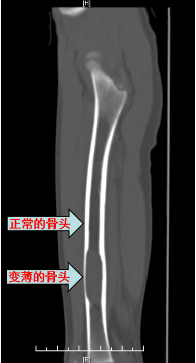 儿童骨囊肿,微创治疗,最大限度降低手术的伤害