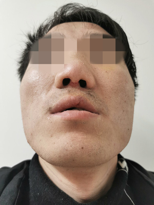 唇裂术后鼻唇畸形 - 好大夫在线