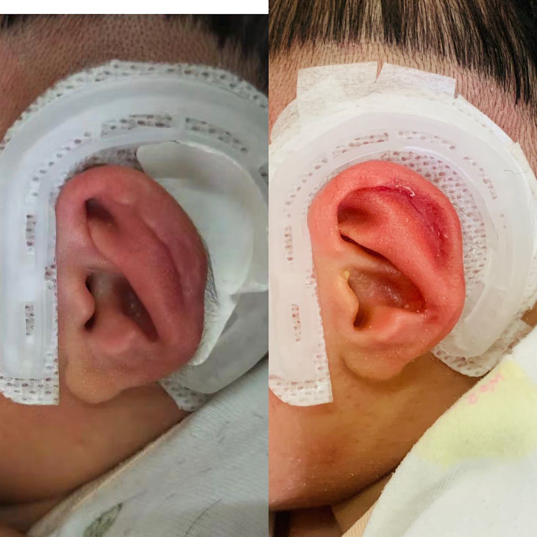 包医一附院耳鼻喉科开展新生儿耳廓畸形的无创矫治 