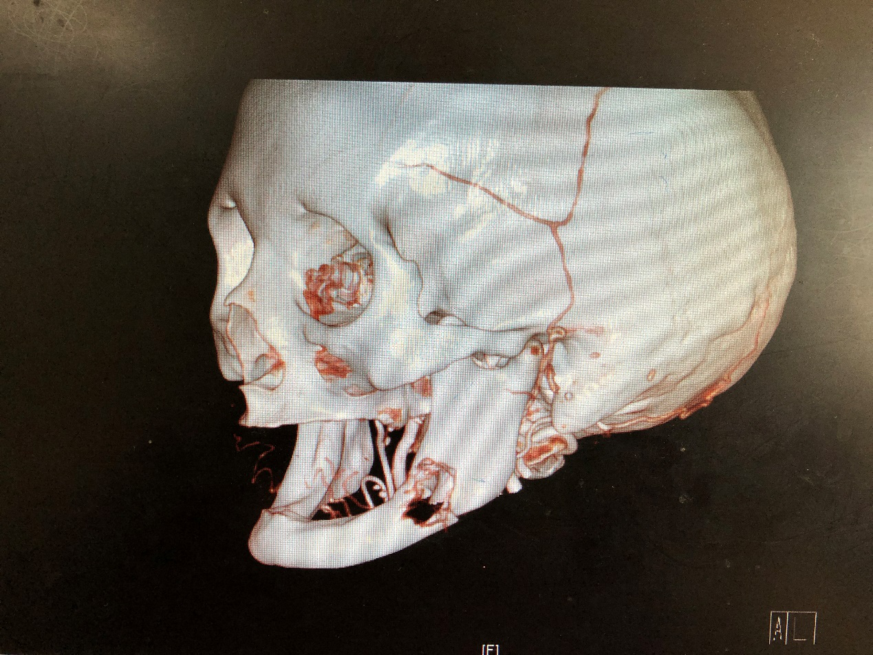 ct和口腔全景片已顯示左下頜體部病理性骨折,我高度懷疑是頜骨中心性