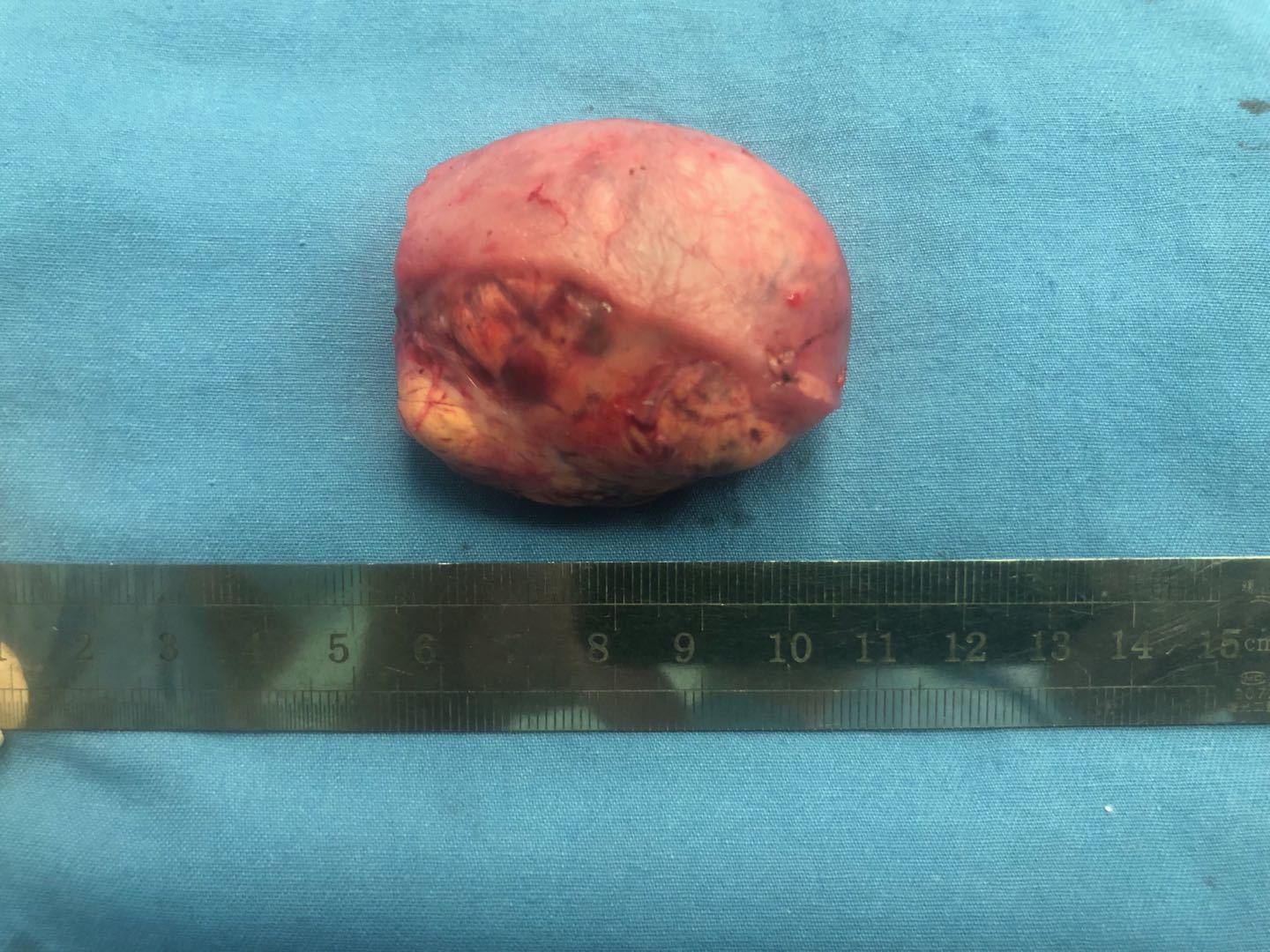 我的手术案例三:右肾中央型肿瘤(5厘米)行腹腔镜肾部分切除一例 