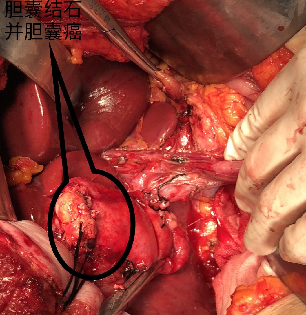 肝胆胰肿瘤低龄化趋势来临 - 好大夫在线