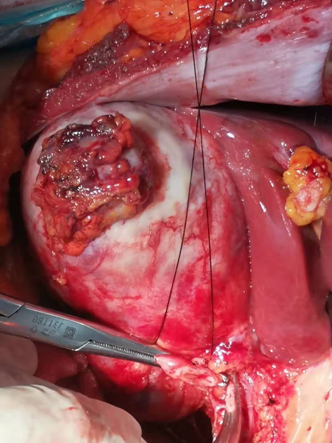 肝胆胰肿瘤低龄化趋势来临 - 好大夫在线