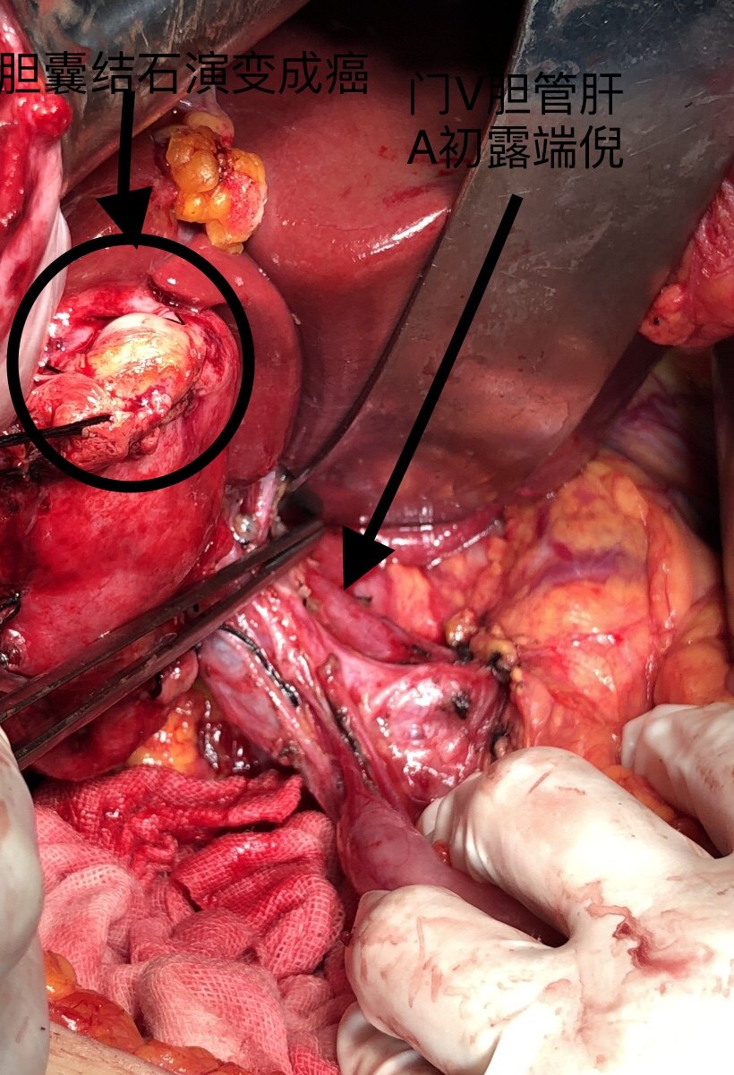 肝胆胰肿瘤低龄化趋势来临 - 好大夫在线