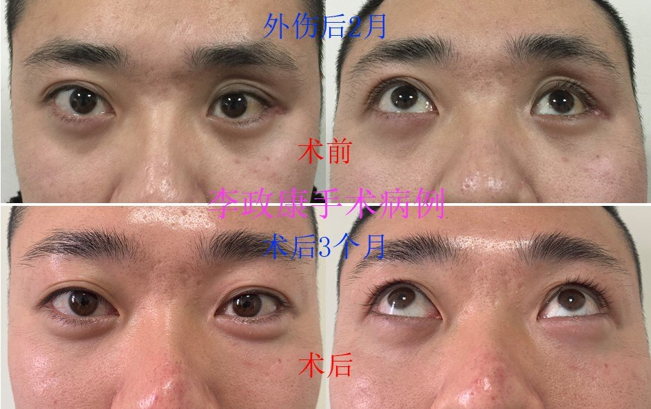 没有告知患者需要治疗,3个月后眼球和面部严重凹陷,经李主任手术治疗