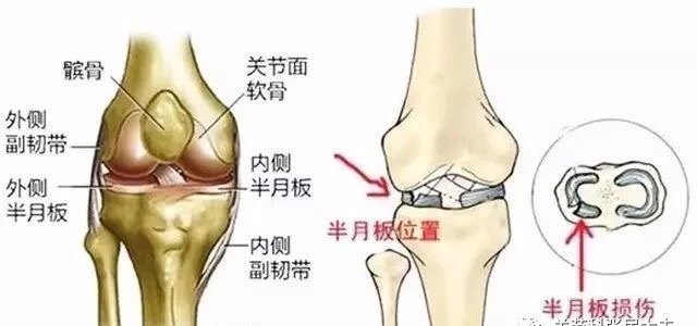 半月板损伤 需要手术吗 膝关节半月板损伤