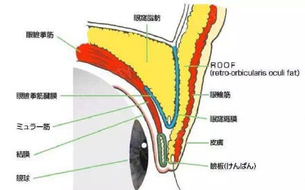 肿眼泡如何做出自然款双眼皮?