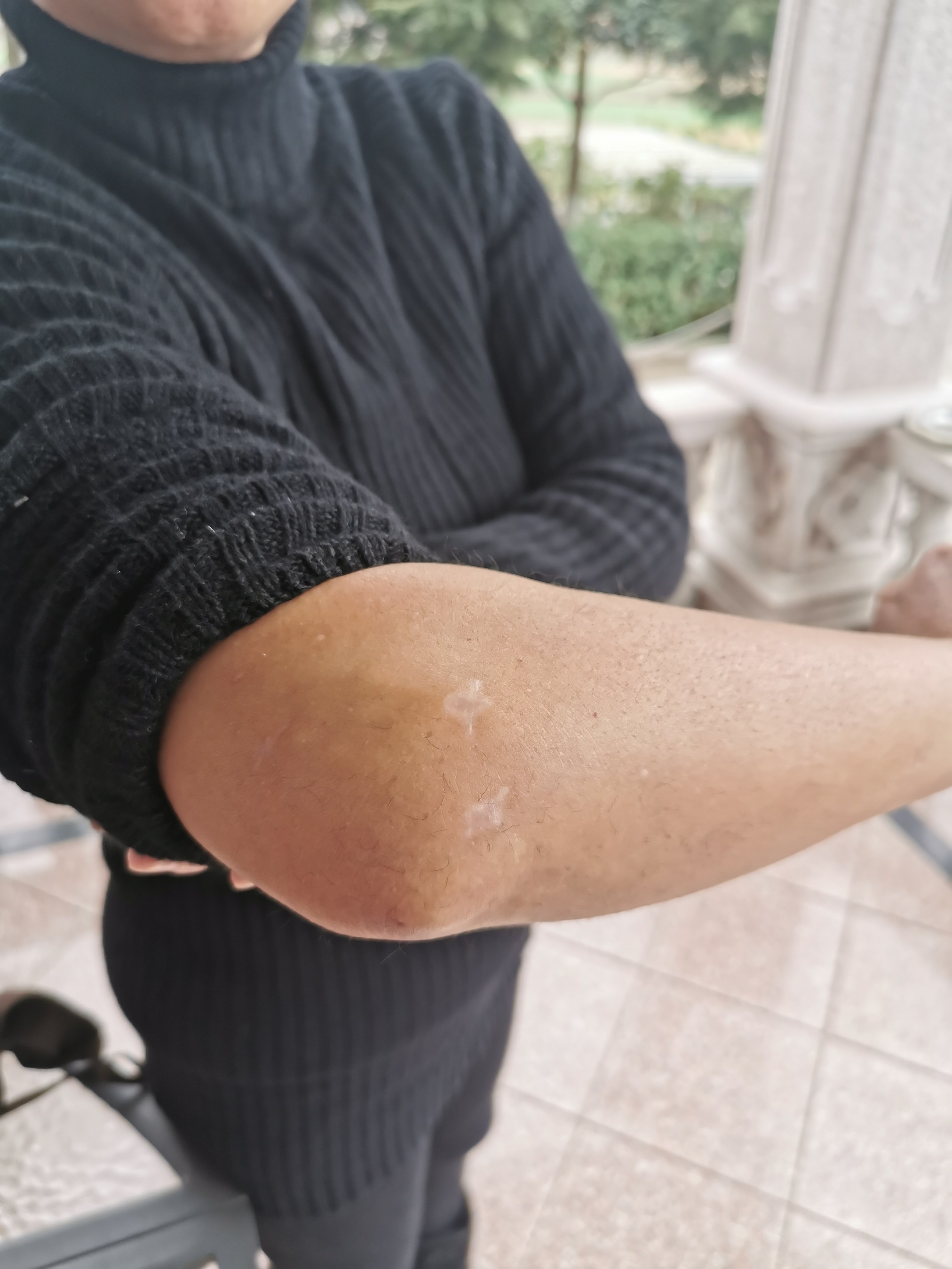 肘关节骨折关节镜下复位内固定术后二个月 好大夫在线 肘关节骨折关节镜下复位内固定术后二个月 好大夫在线