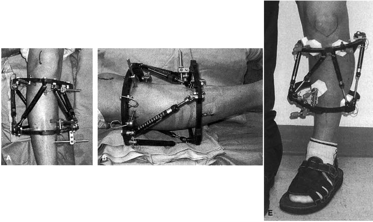 泰勒空间支架(tsf)行骨性关节炎的保膝手术治疗的优势,可避免关节置换
