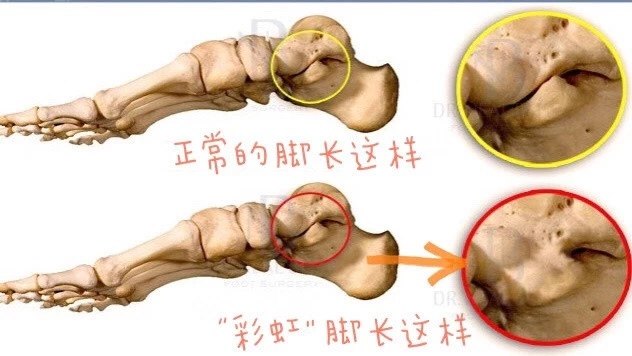 出现在脚上的 彩虹 跗骨联合是什么 先天性足畸形 先天性足畸形