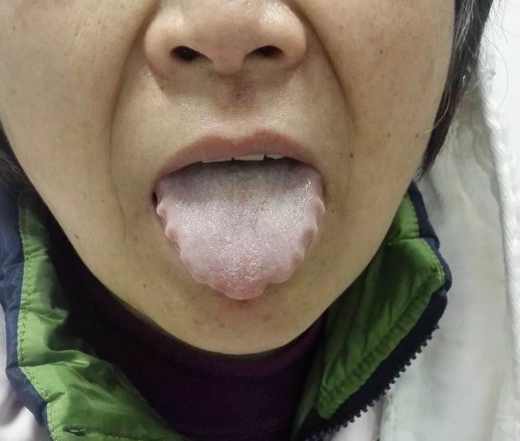比如说齿痕的极端,是锯齿舌:那么,什么叫比较极端的舌像呢?