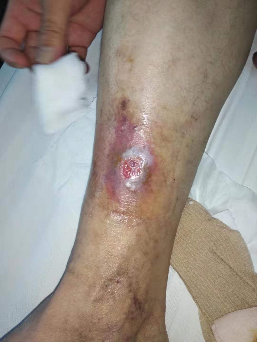如何正确治疗老烂腿_周围血管病_治疗方式_日常注意事项 - 好大夫在线