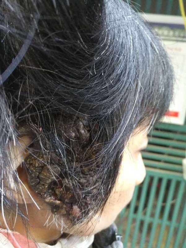 警惕先天巨痣恶变 - 好大夫在线