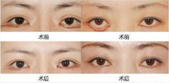 做去眼袋手术失败了 该怎么办 去眼袋 去眼袋