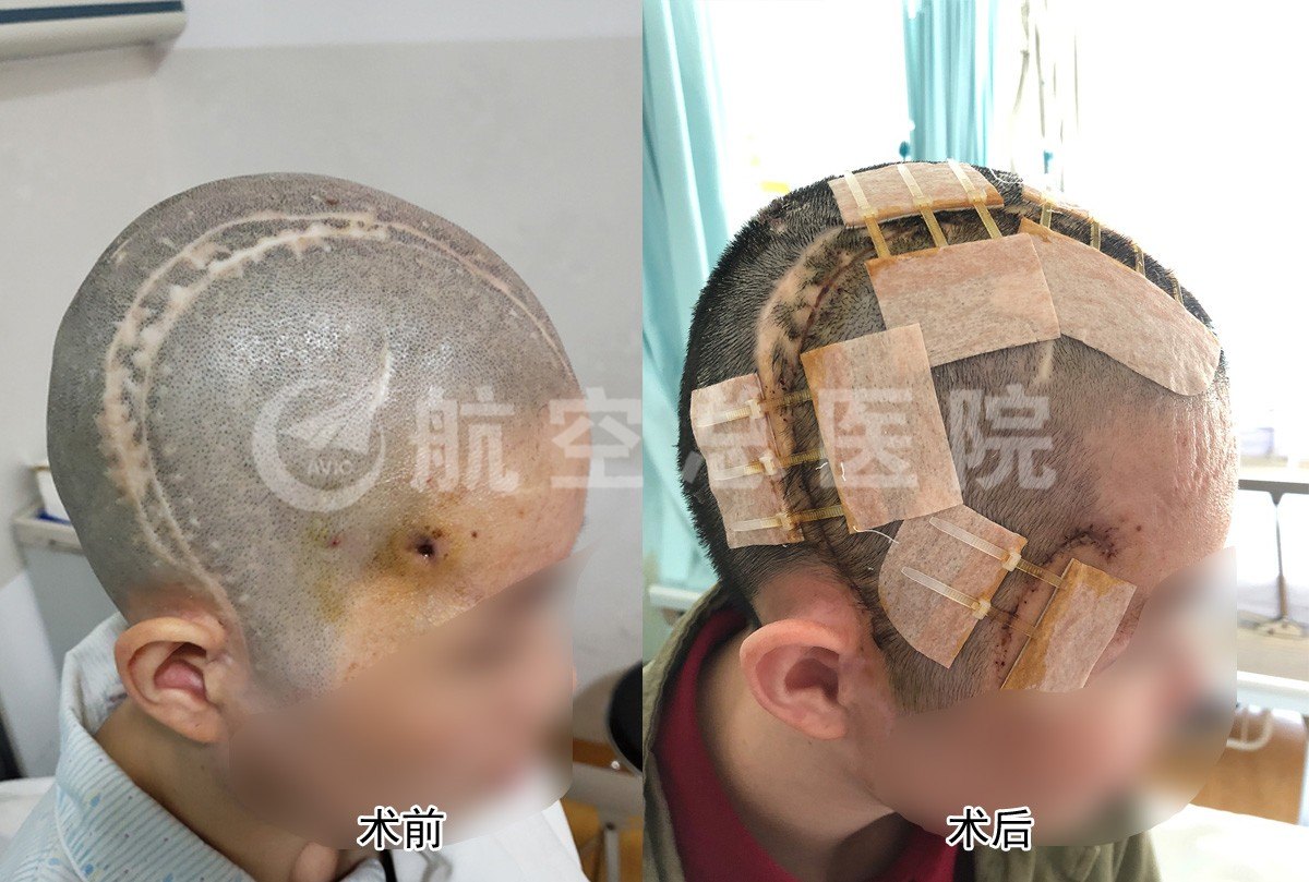 颅骨修补术_颅骨修补术治疗介绍 - 好大夫在线