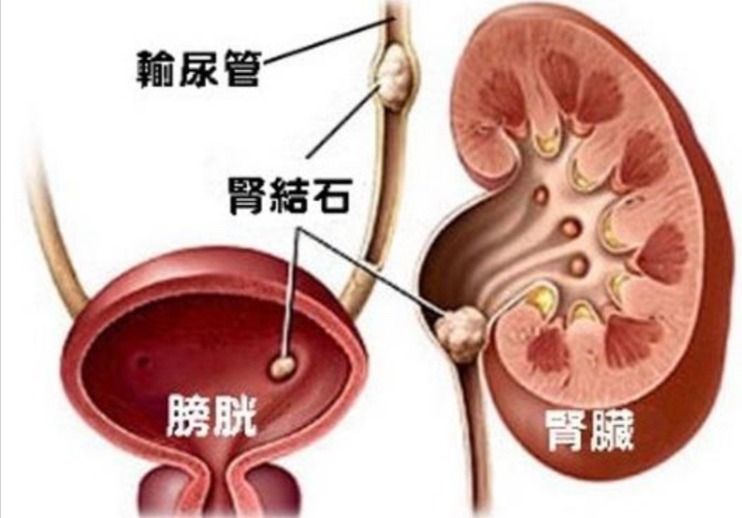 关于输尿管结石的那些事