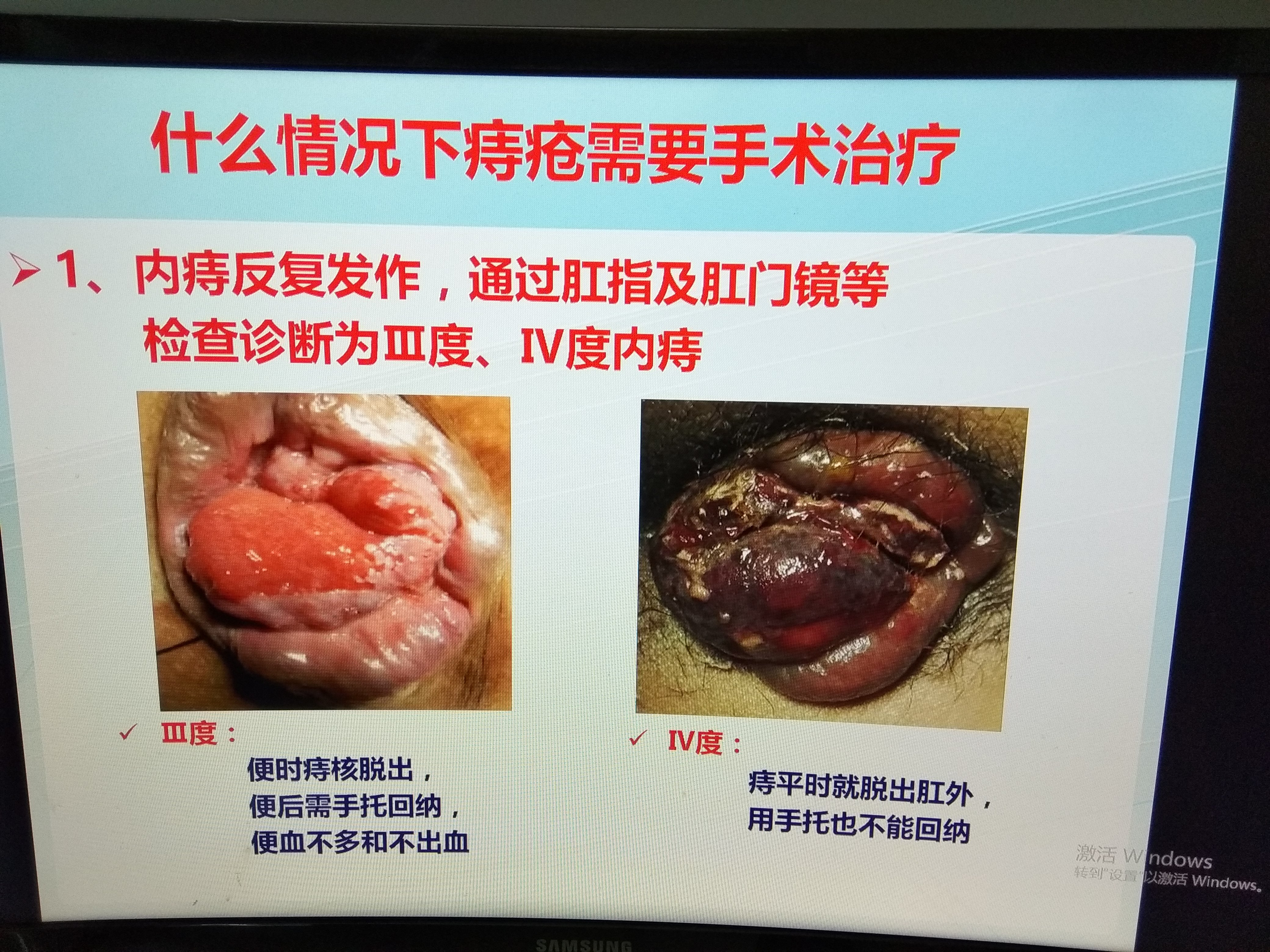 痔疮手术痔核脱落征兆图片