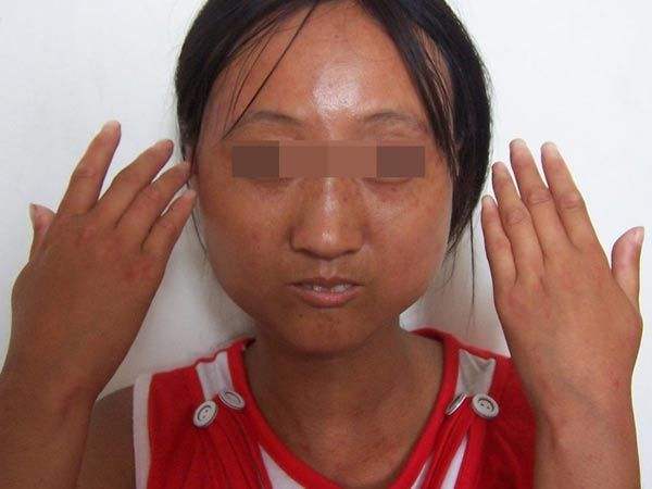 手指头忽红忽白,遇冷还会疼痛,查查风湿,有可能导致严重肺病_雷诺综合