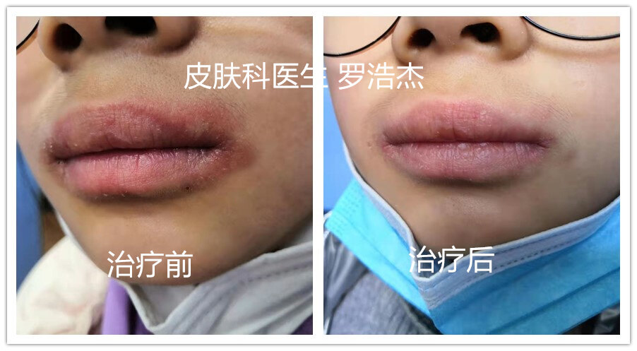 haodf:8:chunyan--> !--haodf:8:chunyan-->唇炎 !