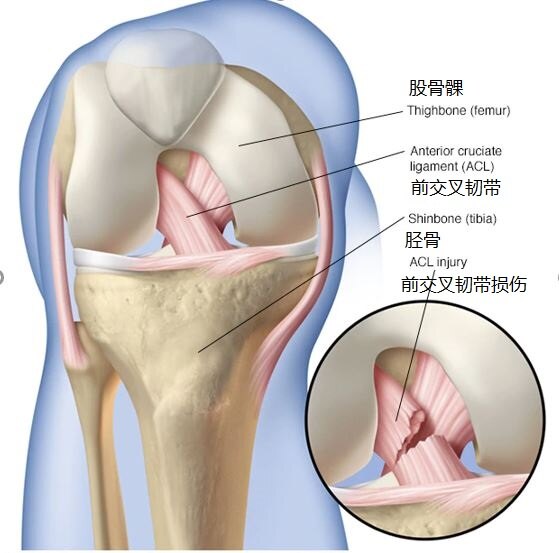 膝关节前交叉韧带损伤 从损伤认识到预防 膝关节韧带损伤