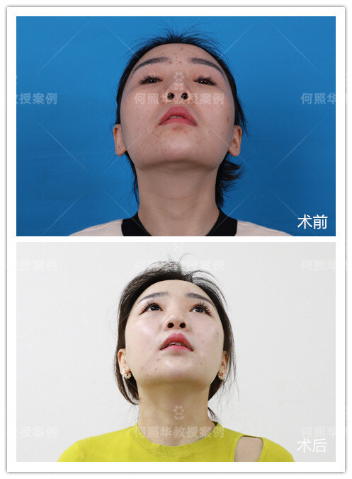 术前分析颧骨有些突出,颧弓外扩,整个人看上去有些严肃;侧面45°来看